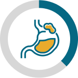Cytoreductive surgery with HIPEC (peritoneal mesothelioma) chart